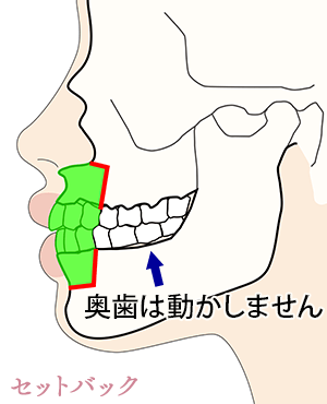 セットバック