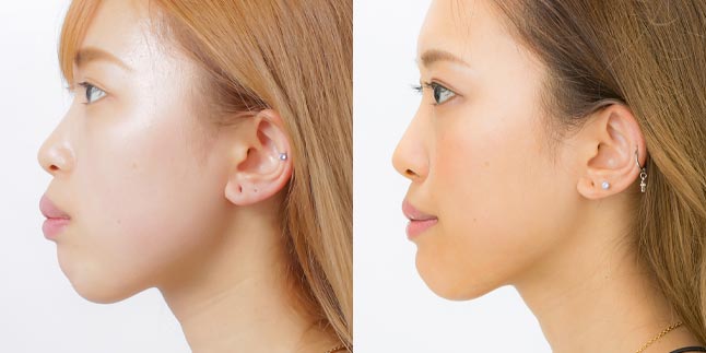 上下セットバック手術