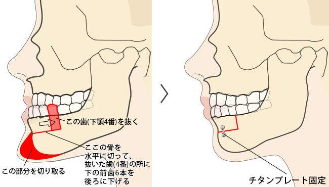 下あごセットバック