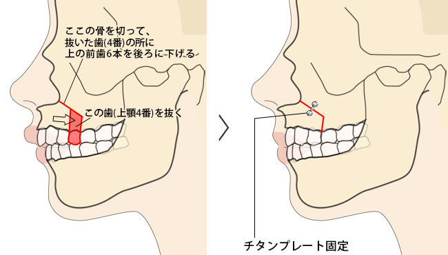 上あごセットバック