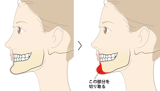 オトガイ形成（しゃくれてる）